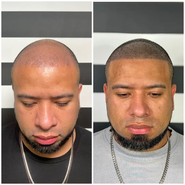 Hairline restoration SMP before and after result 1 at Union Barber SMP Torrance