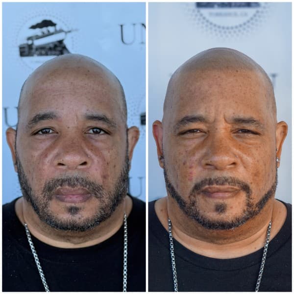 Density Enhancement SMP Before and After - Scalp Micropigmentation Results at Union Barber SMP Torrance