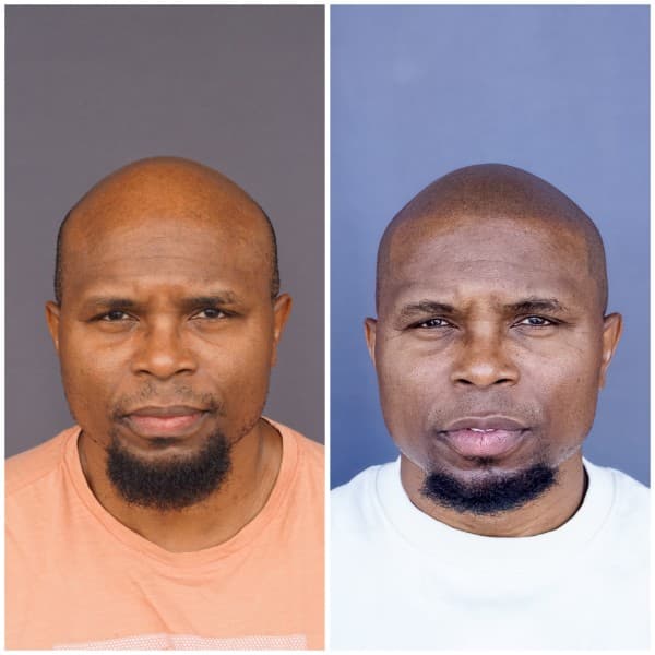 Alopecia SMP Before and After - Scalp Micropigmentation Results at Union Barber SMP Torrance