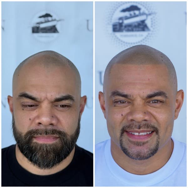 Density Enhancement SMP Before and After - Scalp Micropigmentation Results at Union Barber SMP Torrance