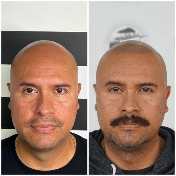 Hairline Restoration SMP Before and After - Scalp Micropigmentation Results at Union Barber SMP Torrance