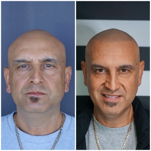 Scar camouflage SMP before and after result 1 at Union Barber SMP Torrance