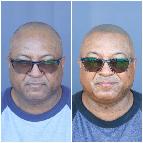 Full Scalp Coverage SMP Before and After - Scalp Micropigmentation Results at Union Barber SMP Torrance