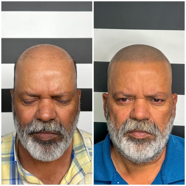 Hairline Restoration SMP Before and After - Scalp Micropigmentation Results at Union Barber SMP Torrance