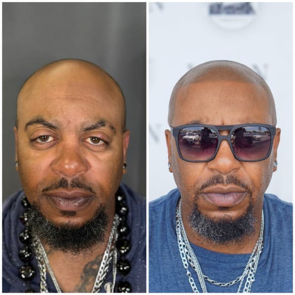 Alopecia SMP treatment before and after result 2 at Union Barber SMP Torrance