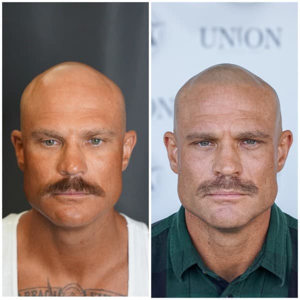 Density Enhancement SMP Before and After - Scalp Micropigmentation Results at Union Barber SMP Torrance