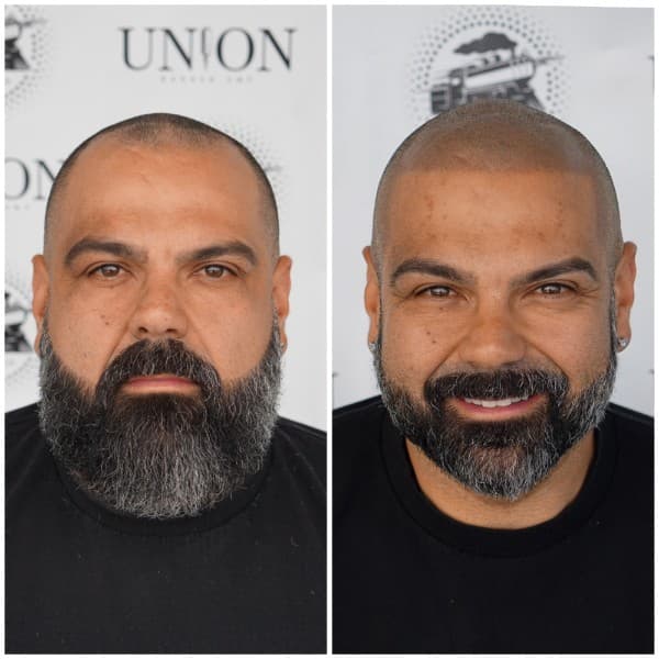 Hairline Restoration SMP Before and After - Scalp Micropigmentation Results at Union Barber SMP Torrance