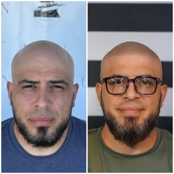 Full Scalp Coverage SMP Before and After - Scalp Micropigmentation Results at Union Barber SMP Torrance