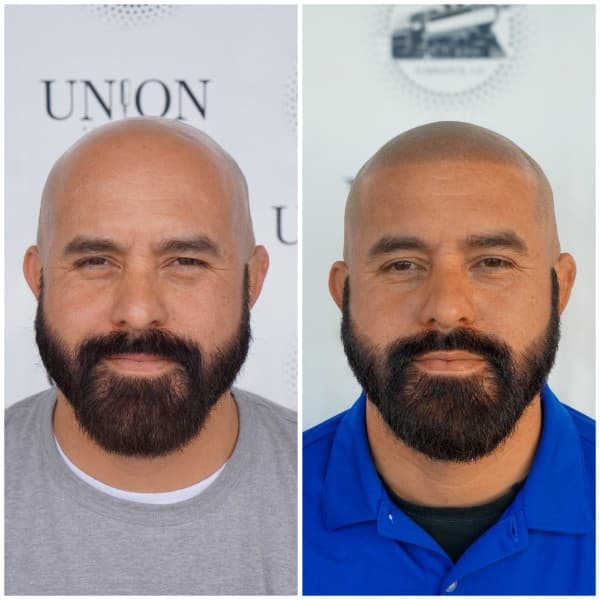 Alopecia SMP Before and After - Scalp Micropigmentation Results at Union Barber SMP Torrance