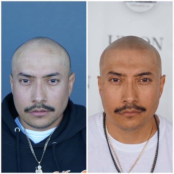 Hairline Restoration SMP Before and After - Scalp Micropigmentation Results at Union Barber SMP Torrance